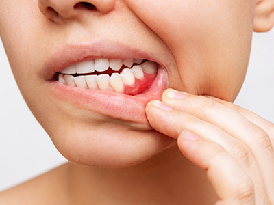 Soft Touch Dental | Oral Hygiene Basics, What is an Endodontist and Chip My Tooth
