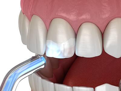The image displays a 3D rendering of an open human mouth with white teeth and pink gums, showcasing dental implants and a toothbrush cleaning inside the mouth.