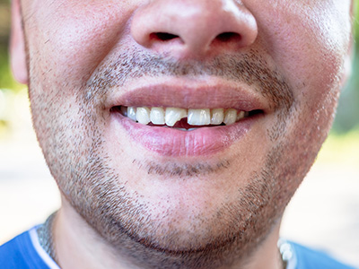Soft Touch Dental | Invisalign reg , Dental Bridges and Extractions