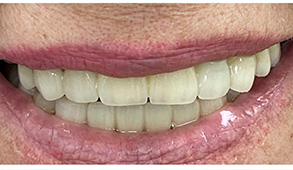 Soft Touch Dental | Cosmetic Smile Makeover, Veneers and Extractions