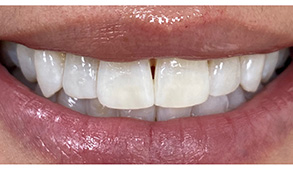 Soft Touch Dental | Dental Anxiety, Do I Have Sleep Apnea and Sports Mouthguards