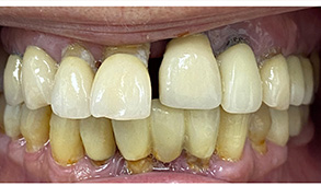 Soft Touch Dental | Dental Bonding, Dentures and Cosmetic Smile Makeover