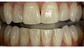 Soft Touch Dental | Why Are My Gums Bleeding , Implant Dentistry and Cosmetic Dentistry