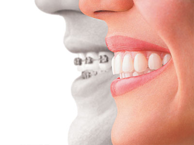 The image shows a side-by-side comparison of a person s natural teeth with an overlay of a dental implant, illustrating the transformation from a missing tooth to a restored smile.