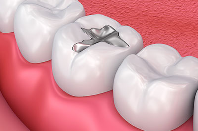 The image shows a close-up view of an upper dental arch with a silver filling in one of the teeth.