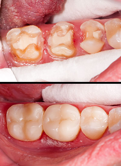 The image displays a close-up view of a person s mouth with severe tooth decay and gum disease, showcasing the damage caused by neglecting dental hygiene.