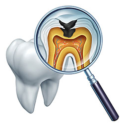The image shows a magnified view of a human tooth with an open crown, revealing the pulp chamber and root canals, viewed through a magnifying glass with a transparent handle, set against a white background.