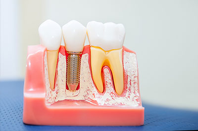 The image shows a model of a human mouth with teeth and gums, featuring an implanted tooth with a screw visible at its base.