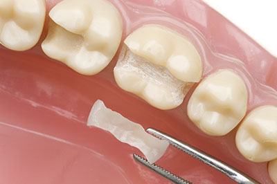 The image shows a close-up view of a dental implant being placed into a prepared tooth socket with visible dentures nearby.
