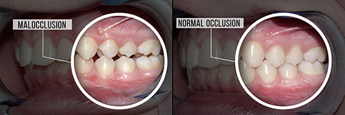 The image shows a side-by-side comparison of an oral cavity before and after a dental procedure, with the top half labeled  normal occlusion  and the bottom half labeled  malocclusion,  indicating the difference in tooth alignment.