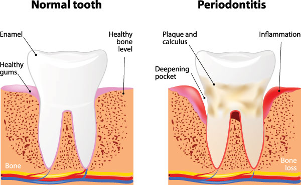 The image shows a detailed illustration of a tooth with gum disease, highlighting normal teeth, bone loss, and stages of periodontitis, including healthy gums, inflammation, and advanced decay.