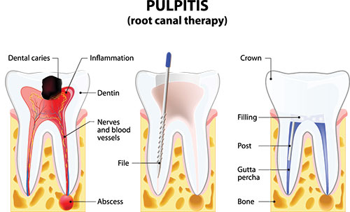 The image illustrates the process of pulpitis, showing a step-by-step diagram of a tooth s structure with annotations indicating the stages of infection leading to dental caries.
