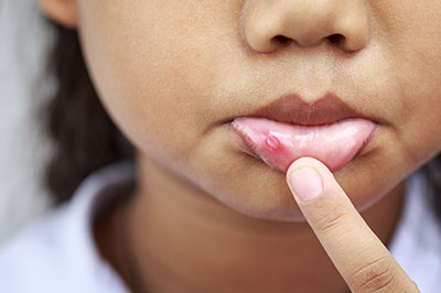 A young child with acne on their face, examining a pimple with their finger.