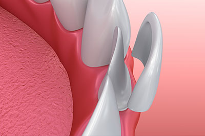 The image shows a close-up view of a dental implant with a screw visible on its surface, set against a pink background that appears to be a representation of gum tissue.