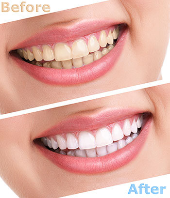 The image shows a smiling woman with teeth before and after cosmetic dental treatment, highlighting the transformation achieved through dental care services.