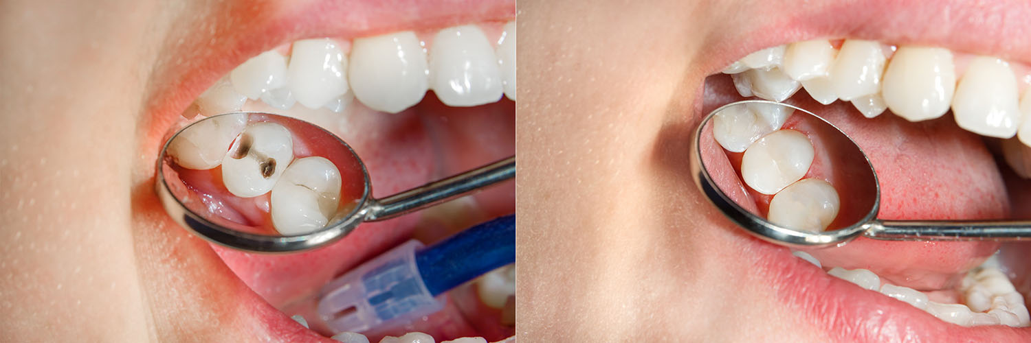 Soft Touch Dental | Preventative Program, Dental Bridges and Veneers