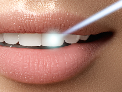 Soft Touch Dental | Invisalign reg , Cosmetic Dentistry and Invisalign vs Traditional Braces