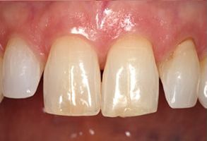 The image shows a close-up of a person s teeth with a focus on dental work, specifically a tooth with a visible filling and a gumline that appears to be affected by gingivitis or a similar condition.