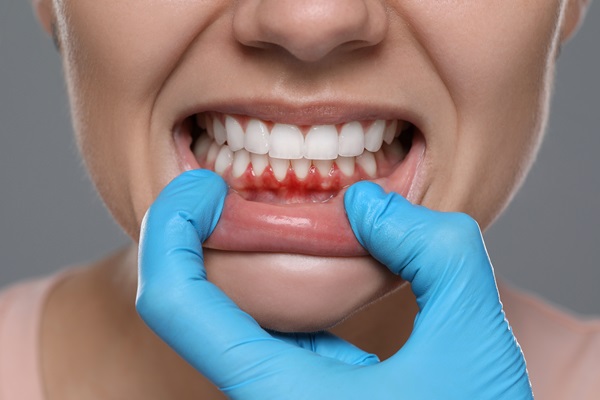 The Types Of Gum Disease